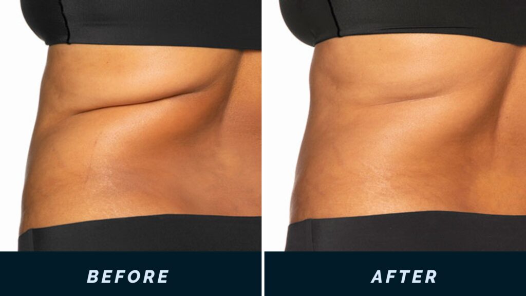 "Woman confidently showing her toned body after CoolSculpting treatment at PÚR MedSpa, highlighting non-invasive fat reduction results."