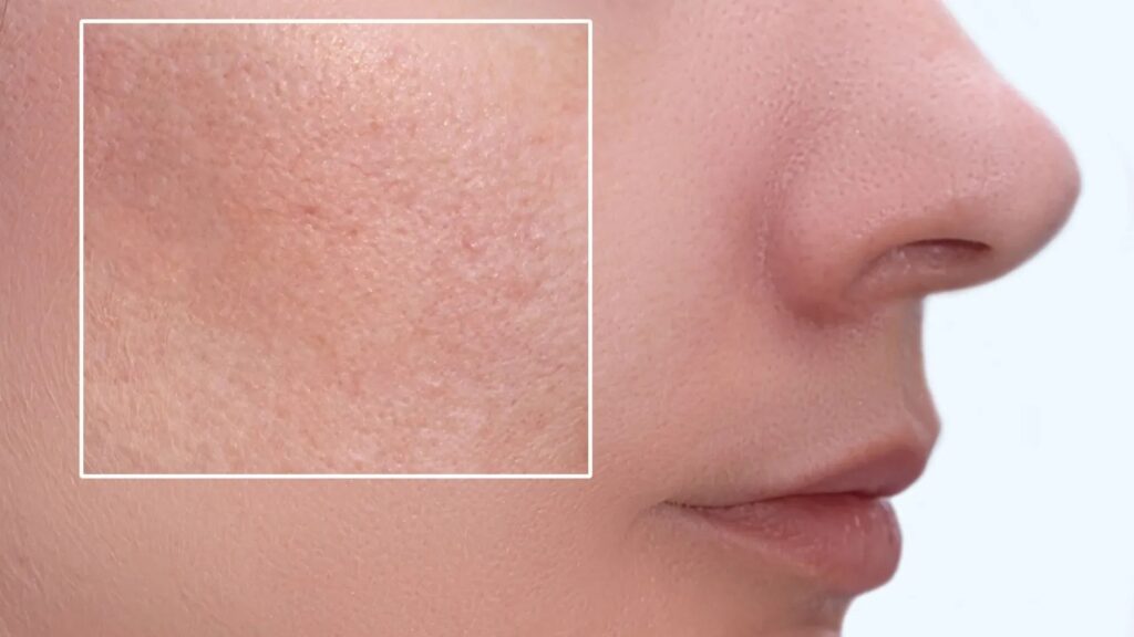 A close-up of smooth, radiant skin after a pore-minimizing treatment, highlighting the even texture and healthy glow.