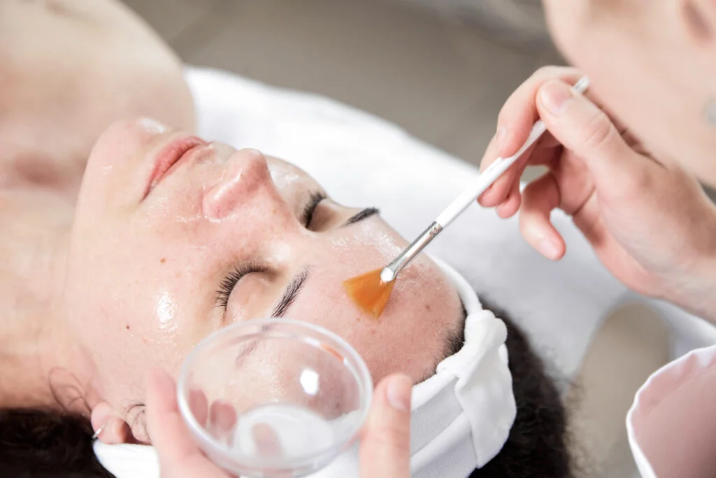 "Close-up of a person receiving a chemical peel treatment on the face in a spa setting"