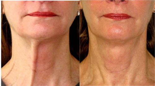 Botox for Neck (Platysmal) Bands