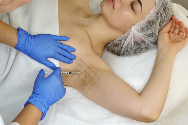 Why Botox is the Best Choice for Stopping Underarm Sweating