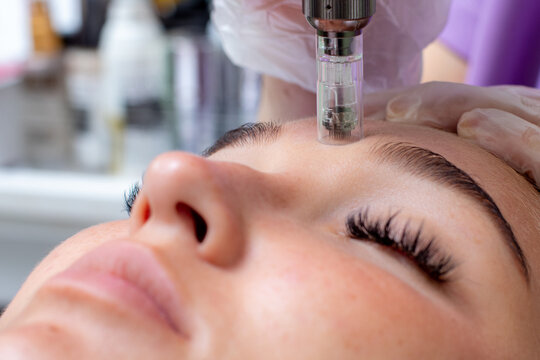 "Close-up of microneedling procedure rejuvenating skin for a glowing look."